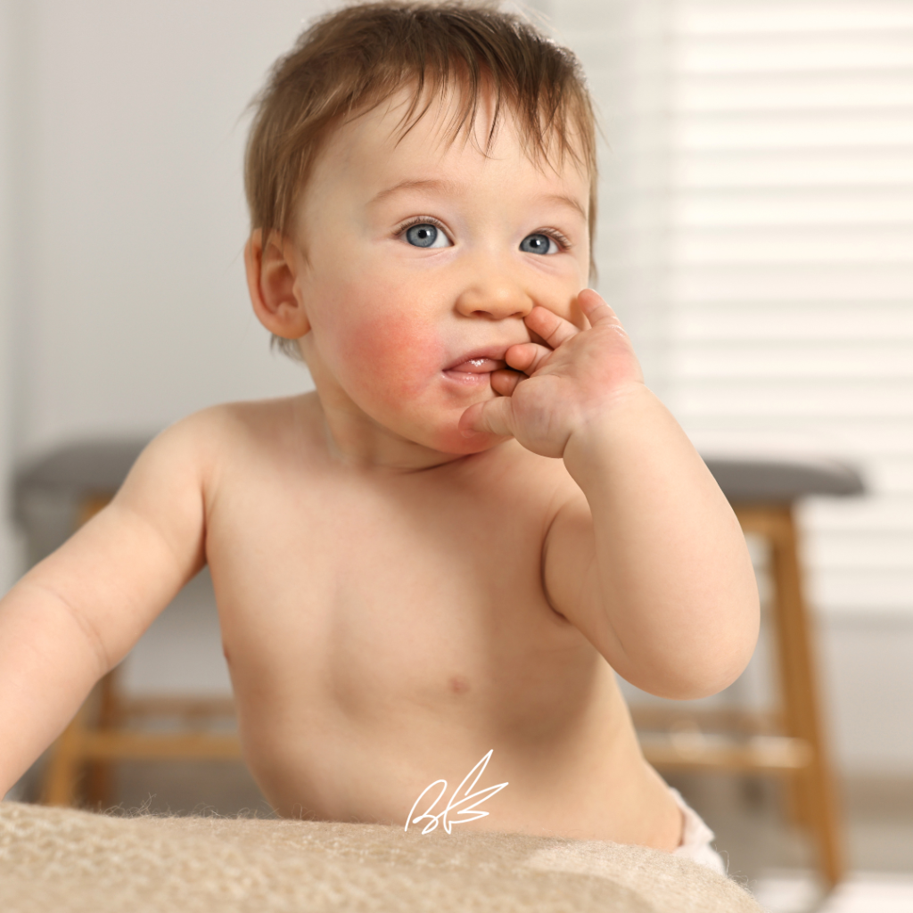 a baby with atopic skin. бебе с атопична кожа.