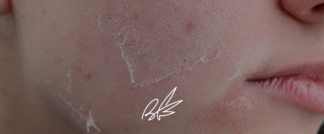 atopic skin