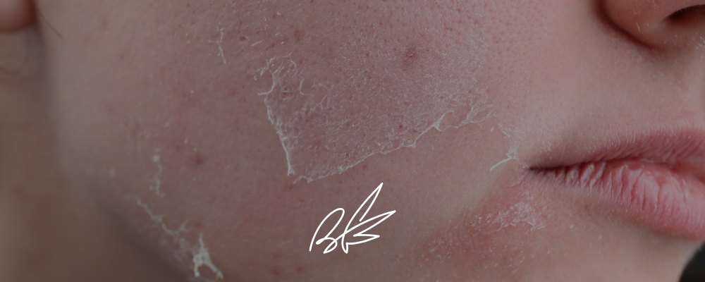 atopic skin